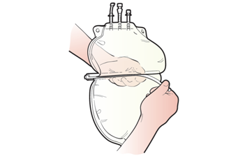 Figure 12. Removing the divider in the middle of the TPN bag