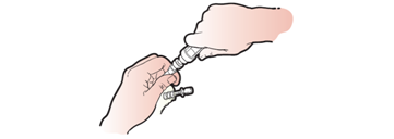 Figure 14. Inserting tip of the administration set into spike port of TPN bag