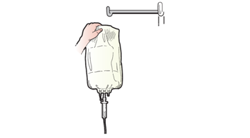 Figure 15. Hanging TPN bag on IV pole