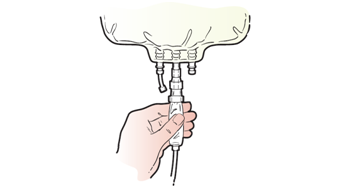 Figure 16. Squeezing the chamber of the administration set