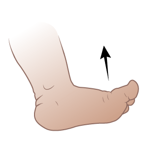 Child's foot flexing towards shin