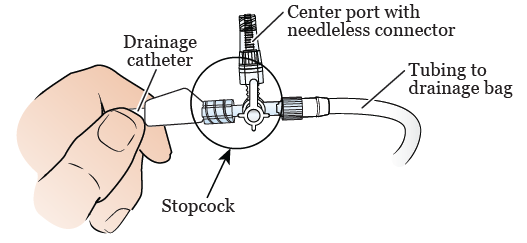 Figura 2. Desconecte la llave de paso del catéter de drenaje