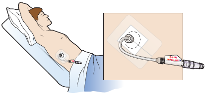 Figure 1. Capped biliary drainage catheter