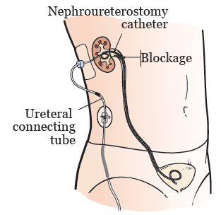 Figure 1. Nephroureterostomy catheter