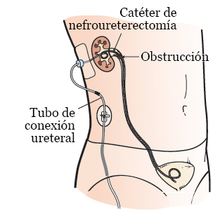 Figura 1. Catéter de nefroureterectomía