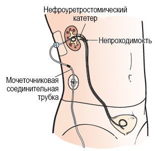 Рисунок 1.  Нефроуретростомический катетер