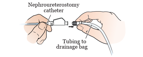 Figure 2. Disconnecting the drainage tubing from your nephroureterostomy catheter