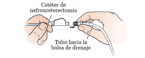 Figura 2. Desconecte el tubo de drenaje del catéter de nefroureterectomía