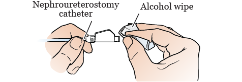 Figura 3. Cómo limpiar el extremo de su catéter de nefroureterectomía