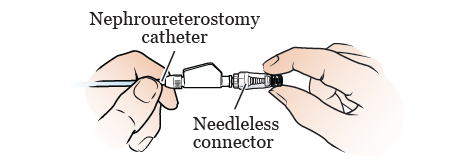 Рисунок 4. Подсоединение безыгольного соединителя к нефроуретростомическому катетеру