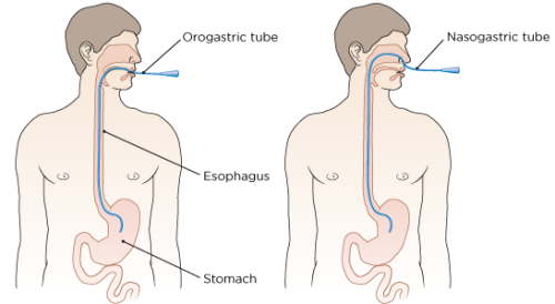 Orogastric (OG) and Nasogastric (NG) tubes