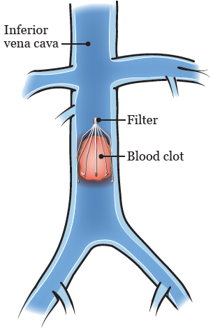 图 1. 下腔静脉 (IVC) 过滤器