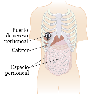 cancer peritoneal tratamiento
