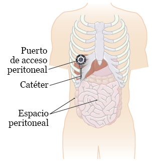 Cancer peritoneal secundario Traducere 