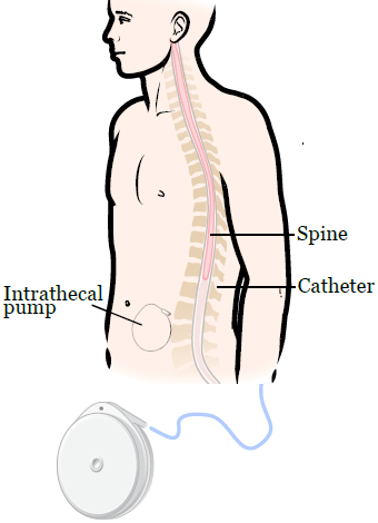 Figure 1. What the Intrathecal pump looks like