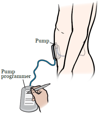 Figure 2. Programming the Pump