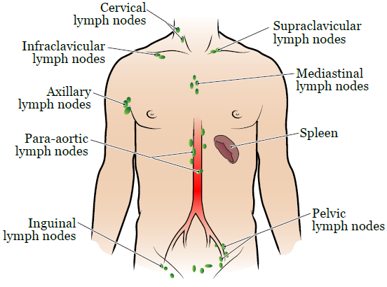 cancer in abdominal lymph nodes symptoms