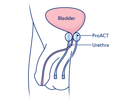 Figure 5. ProACT placement