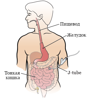 Рисунок 2.  Пищевод, желудок и Е-зонд после операции.