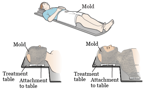 Figura 1. Ejemplos de moldes de radioterapia