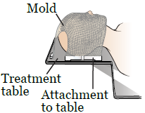 Figura 1. Un ejemplo de un molde utilizado para la radioterapia de todo el cerebro