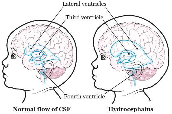 Рисунок 1.  Головной мозг с гидроцефалией и без нее
