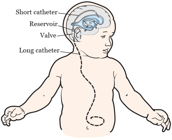 About Your Ventriculoperitoneal (VP) Shunt Surgery for Pediatric