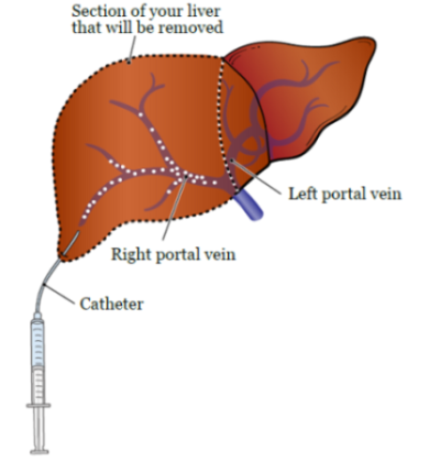 Figura 2. Embolización de vena porta en la vena porta derecha del hígado
