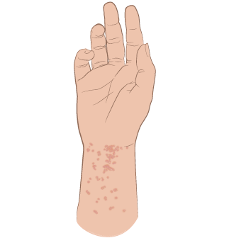 Figure 1. Scabies rash and burrows