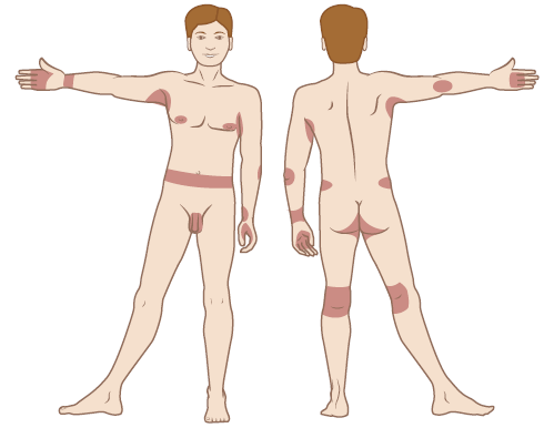 Figure 2. Common locations of scabies rash