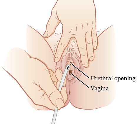 Urinary catheterization  in  pussy Clean intermittent catheterization (CIC): Step-by-step ...