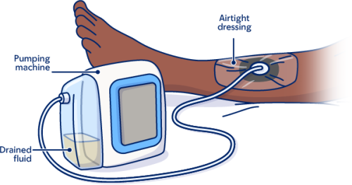 An illustration of a negative pressure wound therapy system on a person's lower leg