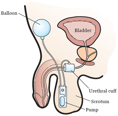 图 2. 人工尿道括约肌 (AUS)