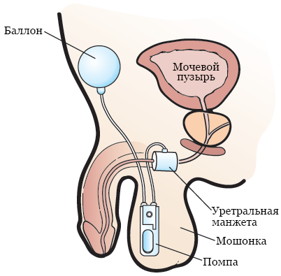 Рисунок 2.&nbsp; Искусственный сфинктер мочевого пузыря (AUS)