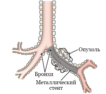 Рисунок 1.  Стент, открывающий суженный участок дыхательных путей