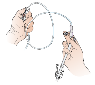 Figure 12. Unclamp feeding tube and open roller clamp