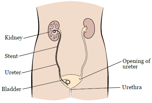 Figure 1. Ureteral stent