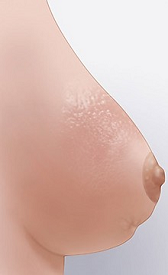 Figure 2. Breast with redness and dimpling