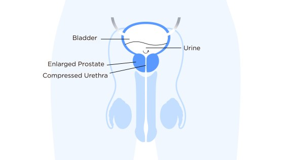 Figure 1. Prostate anatomy 