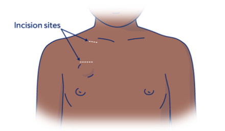 Figure 5. Incision sites for port placement