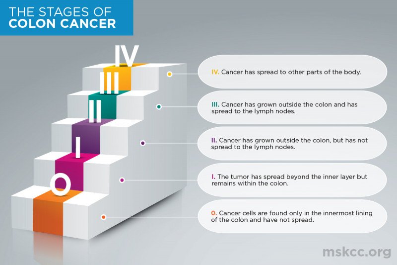 Cancer de colon japon, Cancer colon femme. Cancer colon jeune femme - terapiesicoaching.ro