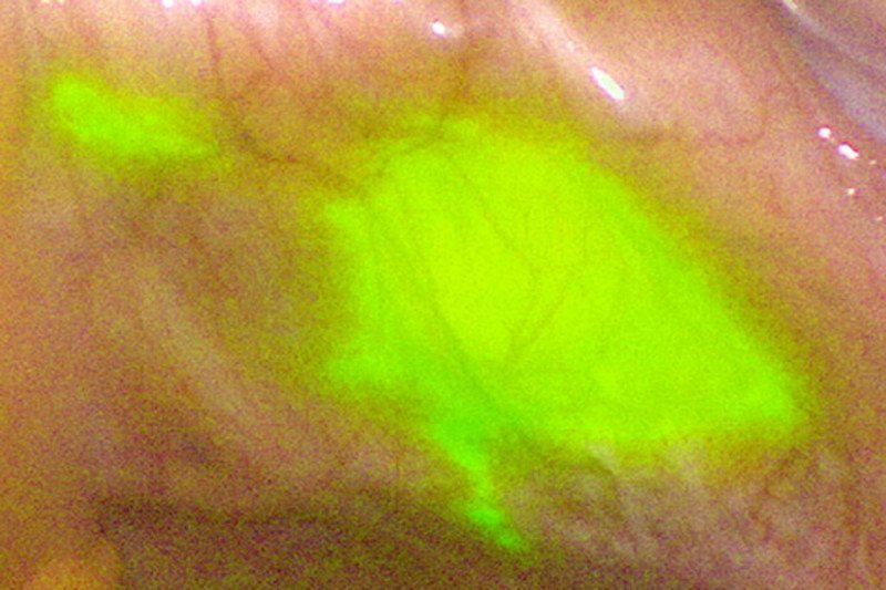 Yellow-green fluorescent dye marking a lymph node among pink tissue in the uterus.