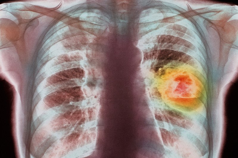 Colored x-ray of lung cancer