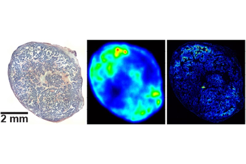 Three images of pancreas tumor