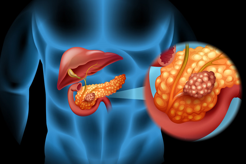 Prognose van pancreaskanker (overlevingspercentage)