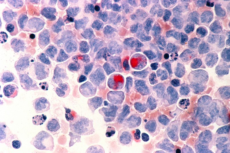 Acute myeloid leukemia cells