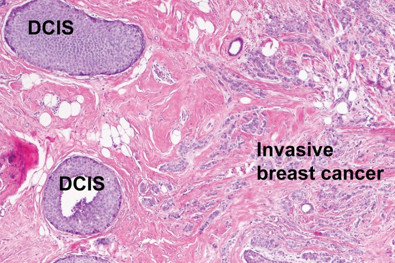 Pathology slide showing DCIS and invasive cancer