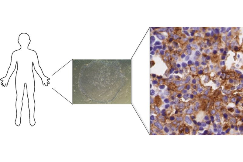 Histology images of stem cells and AML cells