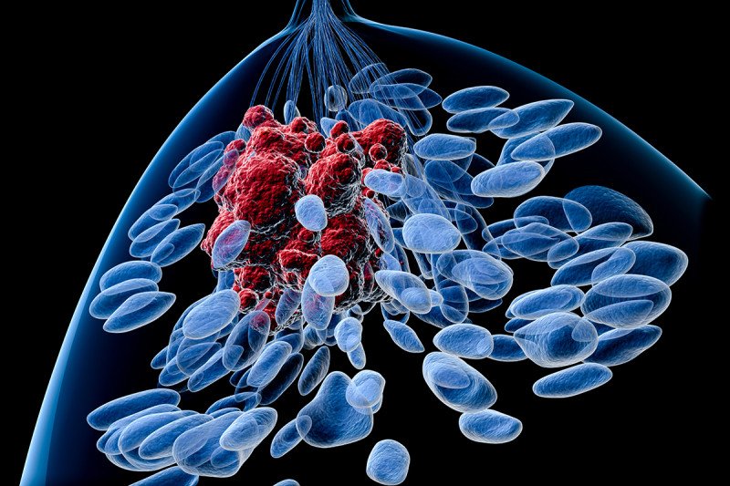 Illustration of breast encompassing blue normal cells and red cancer cells.