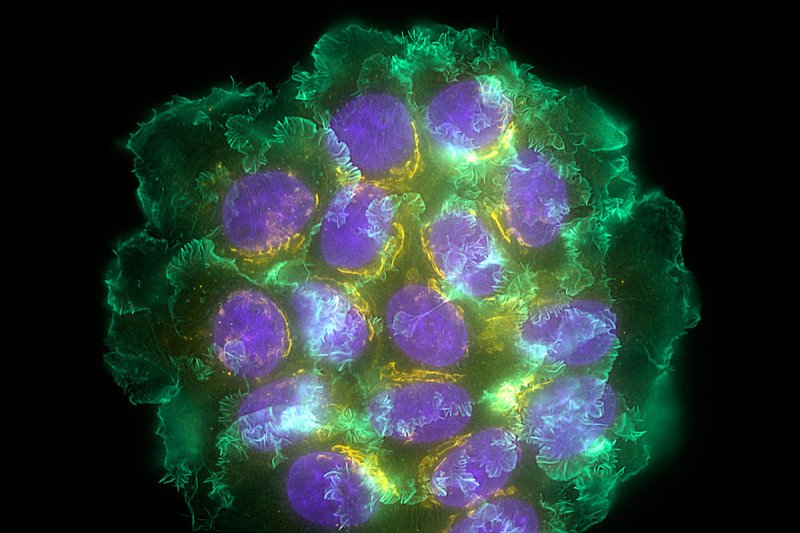 A micrograph image of breast cancer cells.